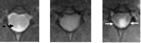 Auch die MRT-Aufnahmen des Rückenmarks zeigen nach dem Verabreichen des neuen Kontrastmittels Gadofluorine deutlich Gewebeveränderungen in den Hintersträngen: Sie sind im Bild rechts außen mit weißen Pfeilen gekennzeichnet. Herkömmliche Methoden zeigen Veränderungen nur schwach (schwarzer Pfeil) oder gar nicht.