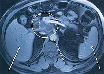 Die mithilfe der Magnetresonanztomographie, einem modernen bildgebenden Verfahren, erstellte Aufnahme, zeigt links die Leber (weißer Pfeil) und rechts die Milz (gestrichelter Pfeil). Der gepunktete Pfeil zeigt auf die Hauptschlagader (Aorta). Der weiße Kreis umschließt einen Tumor der Bauchspeicheldrüse. Alljährlich erkranken in Deutschland rund 13 000 Menschen an Bauchspeicheldrüsenkrebs.