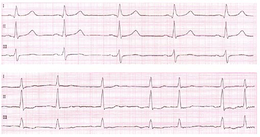 Das Elektrokardiogramm (EKG) zeichnet die elektrische Aktivität des Herzmuskels auf. Oben eine EKG-Aufzeichnung des normalen Herzschlags, unten die EKG-Aufzeichnung eines Patienten mit Vorhofflimmern