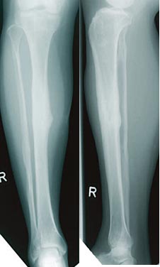 Die Röntgenbilder oben zeigen das Ergebnis der Behandlung ein Jahr nach der Fraktur und dem Entfernen des bioaktiven Implantats.