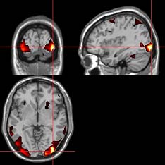 Die Gehirnforschung schreitet in Riesenschritten voran – mittlerweile können Wissenschaftler das Gehirn in Echtzeit bei der Verarbeitung von Sinnesreizen beobachten. Auch in der Altersforschung eröffnen die modernen Verfahren völlig neue Therapieansätze.